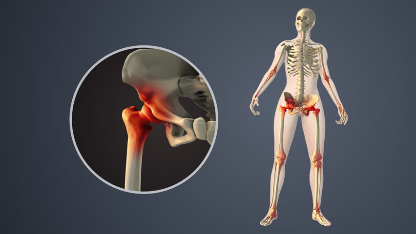 Degenerative Arthritis Affecting Inner Hip Joint Spaces
