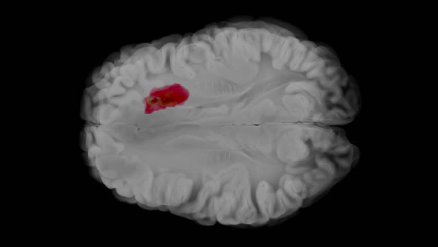 Axial animation of glioblastoma developing in the left frontal lobe. Tumor enlarges with tissue compression and progressive midline shift. Transparent background.