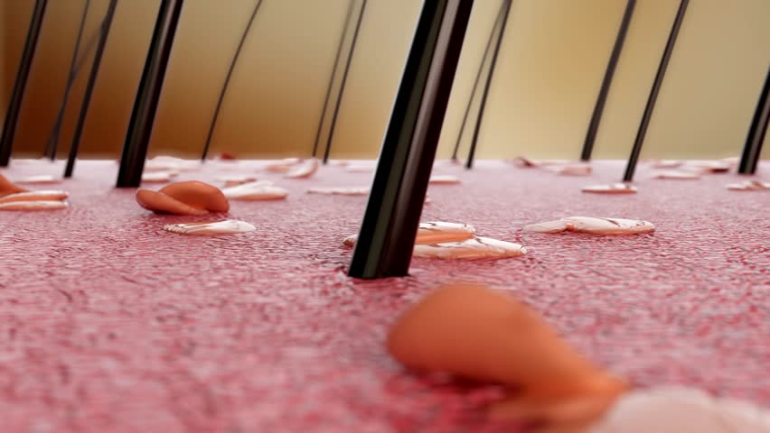 Hair loss, atrophy of hair follicles, damaged hair, oily scalp, increased dandruff, causing many hairs to fall out, bald male before and after hair loss. Shampoo conditioner advertising, 3d animation.