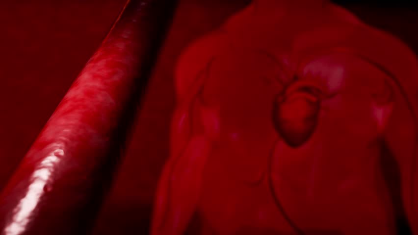 Hyperlipidemia or arteriosclerosis. Blocked artery concept and human blood vessel as a disease with cholesterol fat buildup clogging. Clogged arteries, Cholesterol plaque in the artery. 3D Rendering