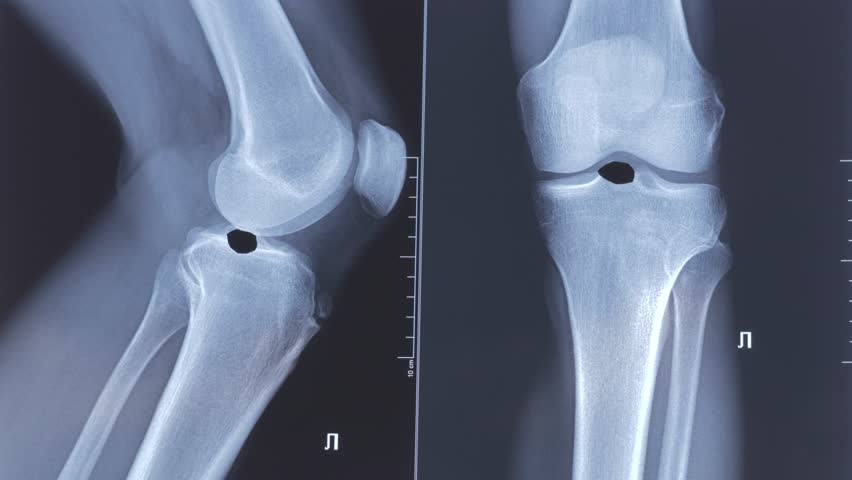 Doctor examining X-ray scan of knee joint. Exostosis on tibia. Cyst formation in the form of a Becker cyst.