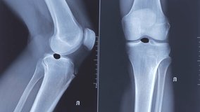 Doctor examining X-ray scan of knee joint. Exostosis on tibia. Cyst formation in the form of a Becker cyst. - Powered by Shutterstock - Get 15% off with code: PIKWIZARD15