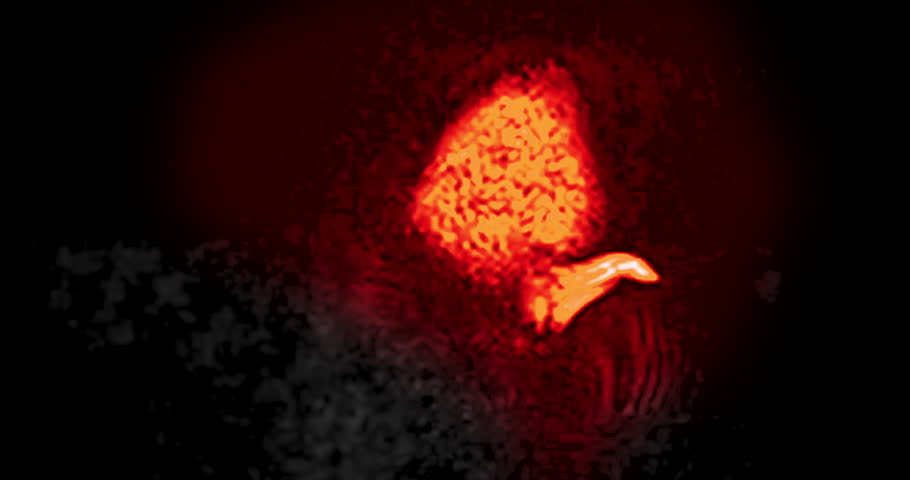 MRI Brain sagittal view can help doctors look for conditions such as bleeding, swelling, tumors, infections, inflammation, damage from an injury or a stroke diseases.