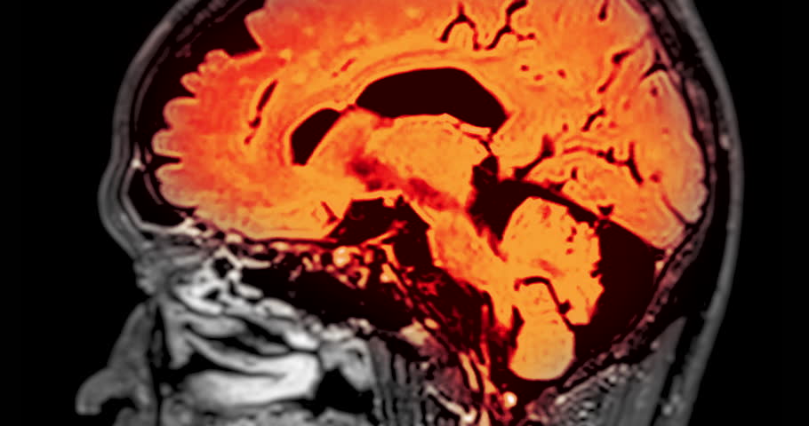 MRI Brain sagittal view can help doctors look for conditions such as bleeding, swelling, tumors, infections, inflammation, damage from an injury or a stroke diseases.