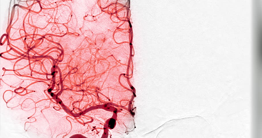 Cerebral angiography footage illustrating contrast dye movement through brain arteries, providing crucial insights into stroke, aneurysms, and vascular malformations.