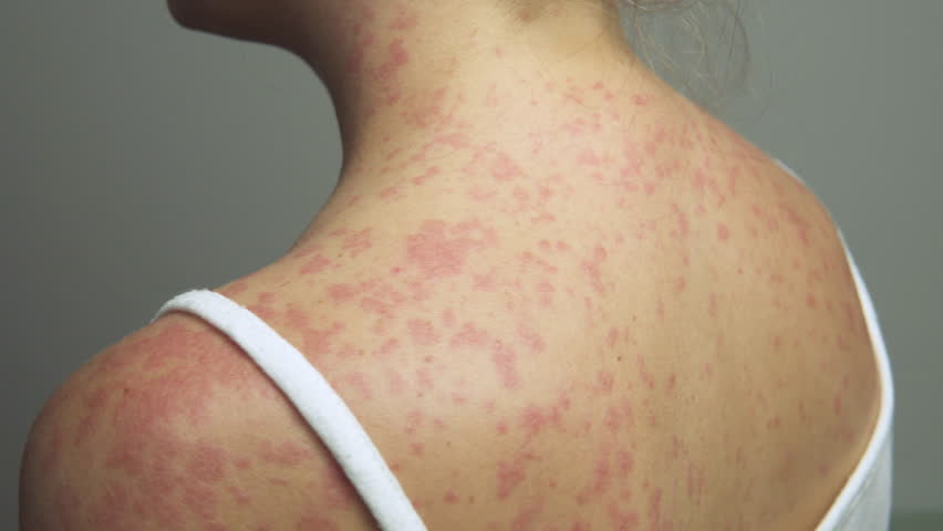 A woman with a red, spotty rash on her upper back and shoulders caused by measles.