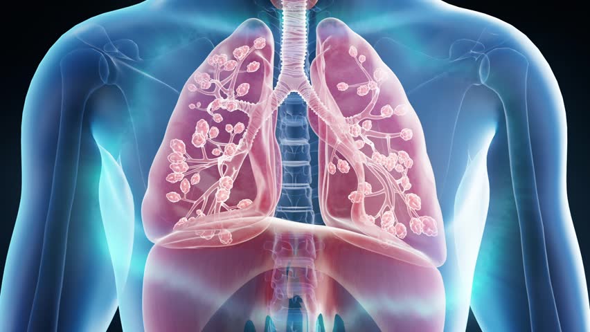 Pneumonia recovery, sick lungs turning into healthy lungs, alveoli facilitate breathing and oxygenation, smoker's lung disease, respiratory system, bronchial, asthma infection recovery, 3d animation.
