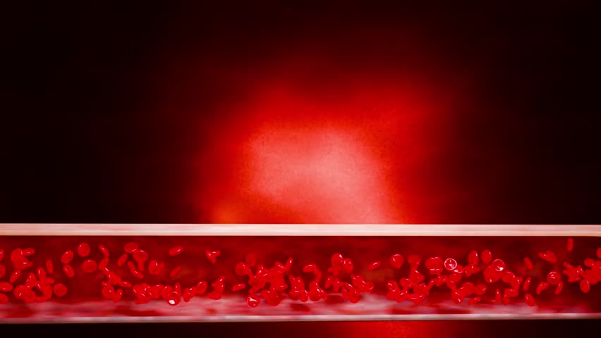 3D medical concept showing artery plaque formation due to high LDL cholesterol, poor nutrition, excessive sugar intake, alcohol consumption, lack of exercise leading to heart disease. 3D rendering