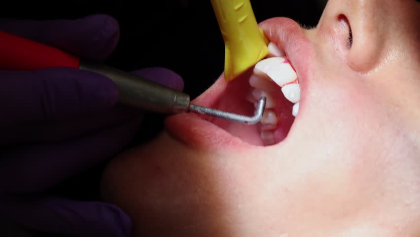 Dental Cleaning Procedure With Ultrasonic Scaler , Close-up video of a dental hygienist using an ultrasonic scaler to clean a patient's teeth during a routine dental check-up.  