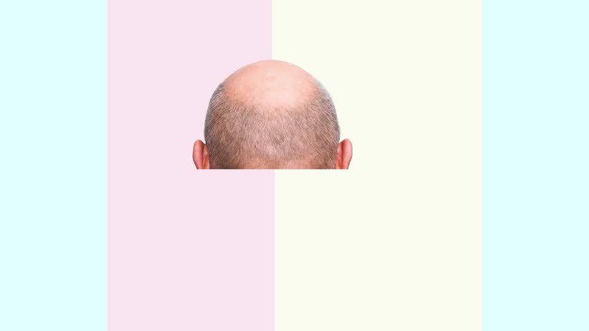 2D animation. Methods of hair transplantation FUT and FUE fue with transplant as infographic element of illustration. Human alopecia or hair loss problem on adult man. Before after concept