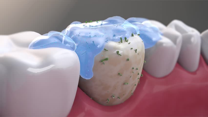 Removing plaque, where bacteria accumulates on the tooth surface, toothpaste or mouthwash cleans plaque and strengthens the tooth surface. Before and after comparison. Oral hygiene product ads, 3d.