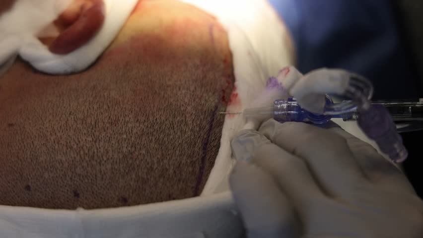 A close-up capturing the injection of local anesthesia into the scalp to numb the area before harvesting hair follicles for transplantation