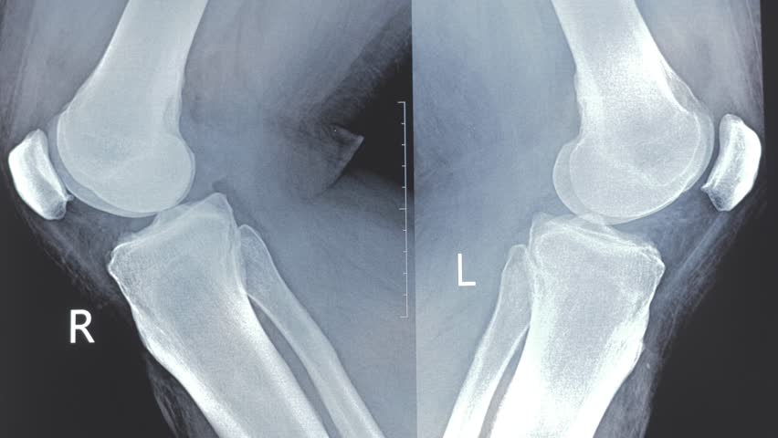 Doctor learning medical X-ray with fracture of knee bones after accident. 4k footage.