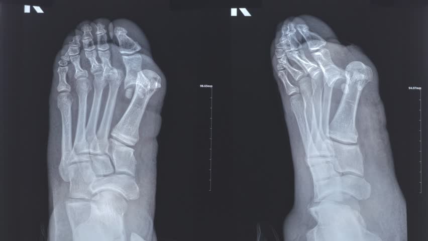 Doctor learn Medical X-ray with leg toe dislocations. Hook-shaped deformity of the finger. Lisfranc joint, Foot fractures. 4k footage.