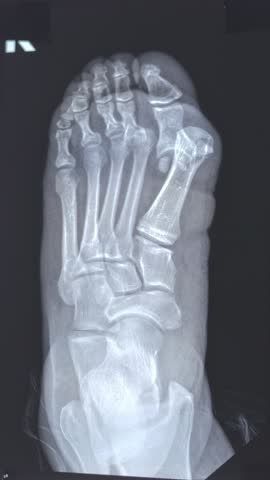 Vertical footage of doctor learn Medical X-ray with leg toe dislocations. Hook-shaped deformity of the finger. Lisfranc joint, Foot fractures. 4k footage. Top view.