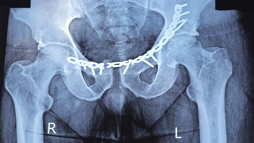 Doctor learn X-ray with broken implanted titanium plate in human pelvis bones. Man need re-operation. Repeat medical surgery. 4k footage.