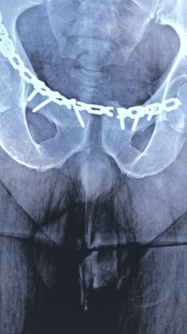 Vertical footage of doctor learn X-ray with broken implanted titanium plate in human pelvis bones. Man need re-operation. Repeat medical surgery. 4k video.