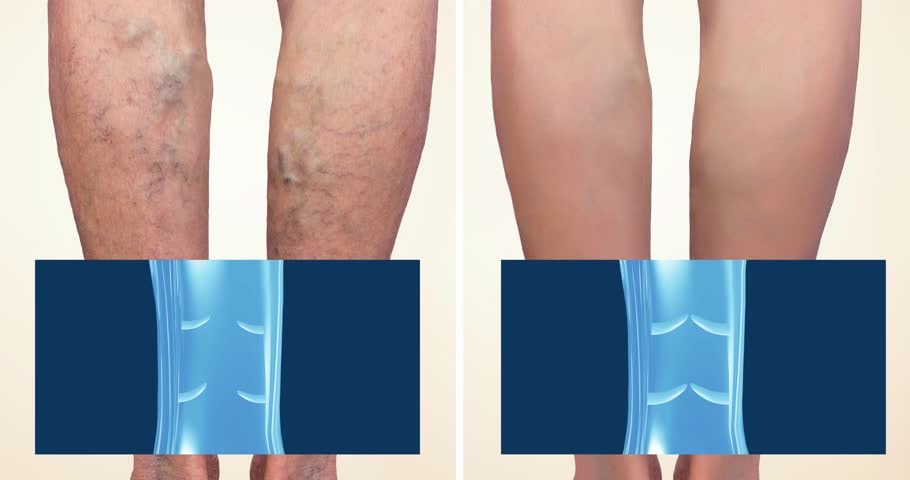 Varicose veins on a female senior legs. The structure of normal and varicose veins. Concept of dry skin, old senior people, varicose veins and deep vein thrombosis or DVT - 2D animation
