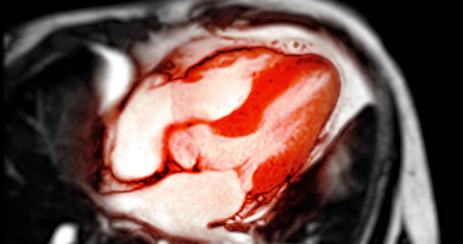 Advanced MRI heart stress test revealing detailed cardiac function under controlled conditions, aiding in early diagnosis and treatment planning.