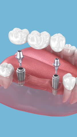 Dental bridge based on two implants. Medically accurate 3D Animation of human teeth and dentures concept