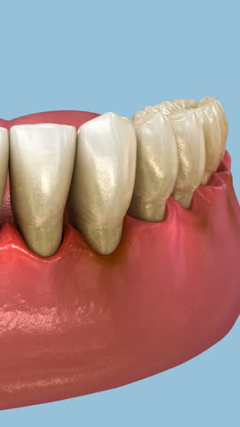 Periodontal - pathological inflammatory condition of the gum in progress. Dental 3D Animation