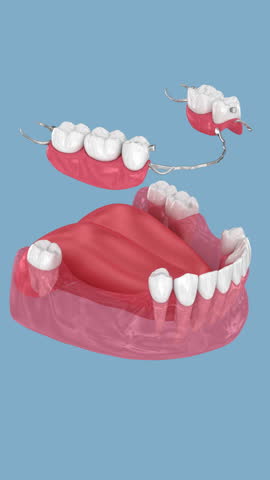 Removable partial denture, mandibular prosthesis. 3D animation