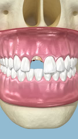 Bone grafting augmentation, socket preservation, tooth implantation. Medically accurate 3D animation