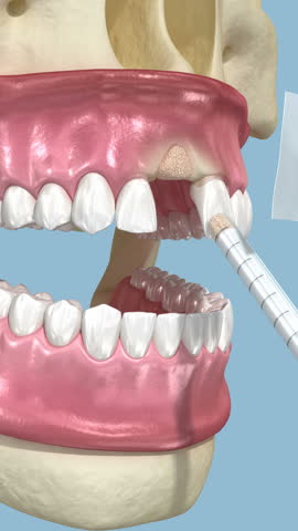 Bone grafting augmentation, socket preservation, tooth implantation. Medically accurate 3D animation