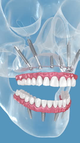 Dental prosthesis supported by zygomatic implants. 3D illustration
