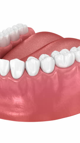 Cracked tooth, splitted. Dental 3D animation