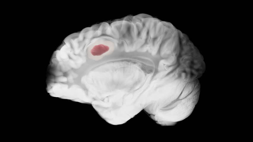Medical animation of progressive glioblastoma growth in the left frontal lobe, shown in sagittal brain view on a black background.
