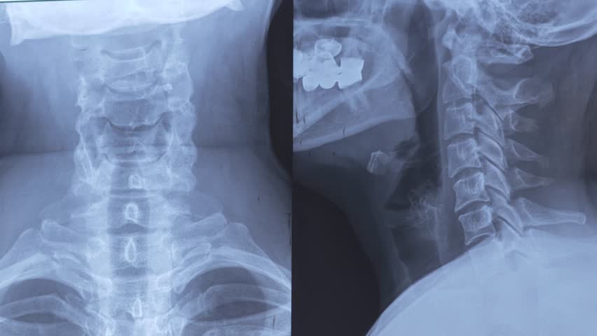 X-ray with cervical lordosis. P-signs of osteochondrosis of the cervical spine Def. spondylosis, spondyloarthrosis. Examination of the cervical spine diseases.