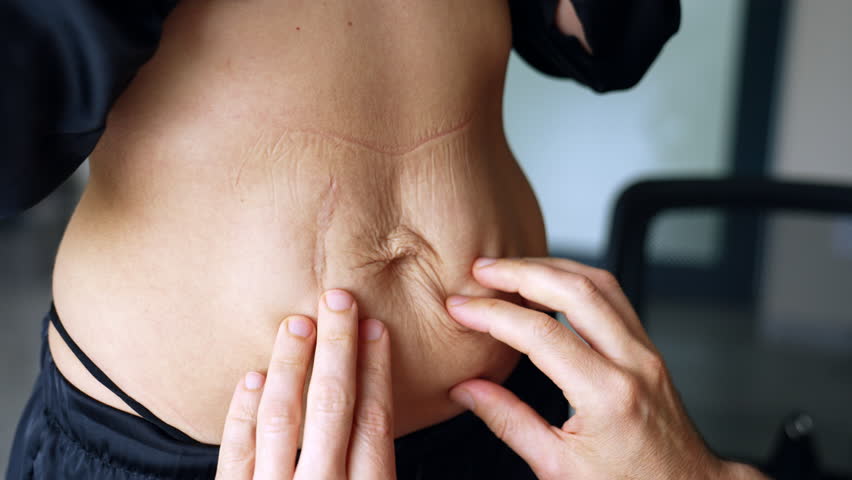 Loose wrinkled extra skin on the belly of unrecognized woman. Male hands check the area for future plastic surgery.