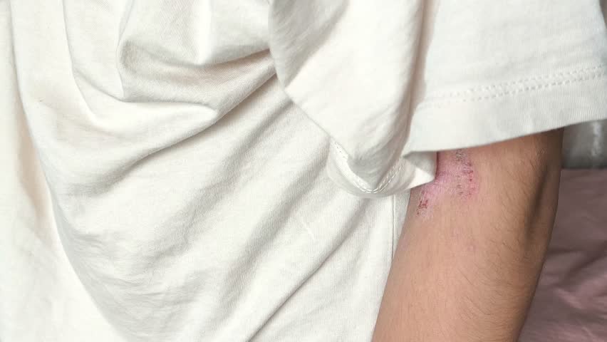 Atopic dermatitis AD, atopic eczema, skin inflammation on the hands. Bloody wounds from atopic dermatitis on the wrist and elbow.