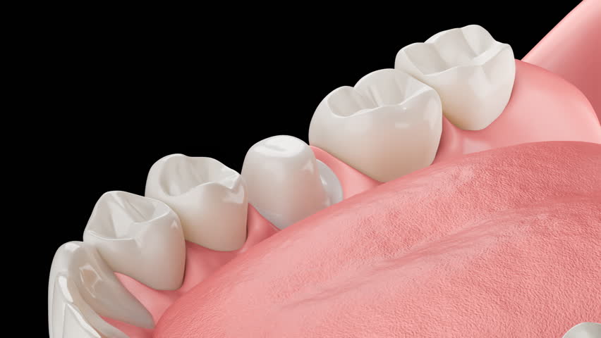 3D animation showing the process of dental crown assembly, medical treatment of human teeth.