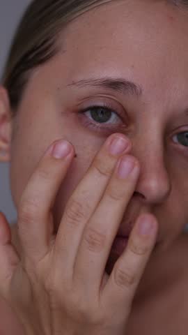 Vertical video of a young caucasian woman showing dark circles under her eyes with hand. Pale skin, bruises under the eyes are caused by disease, fatigue, lack of sleep, insomnia, stress