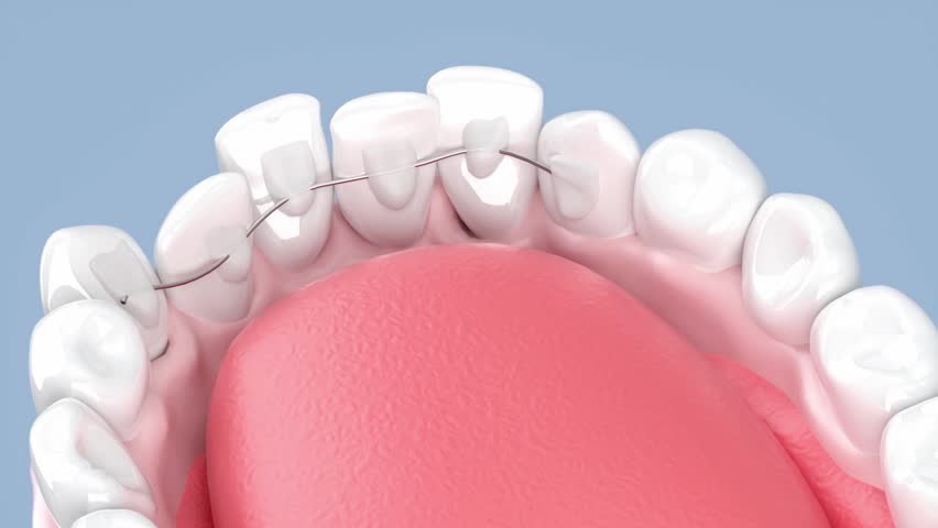 Orthodontic treatment, wearing invisible braces inside lower teeth to restore straight teeth, close up of human teeth model for orthodontic treatment and dental care, 3D rendering.