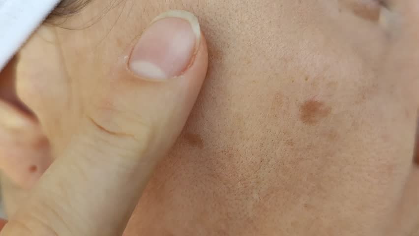 Women's skin 40-50 years old, pigmented dark spots on the face, enlarged pores. Care and cosmetology. Simple close-up video.