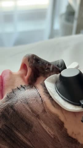 Young woman getting carbon laser facial at beauty clinic. Professional skincare treatment for deep pore cleansing, acne reduction and skin rejuvenation. Modern cosmetology procedure.