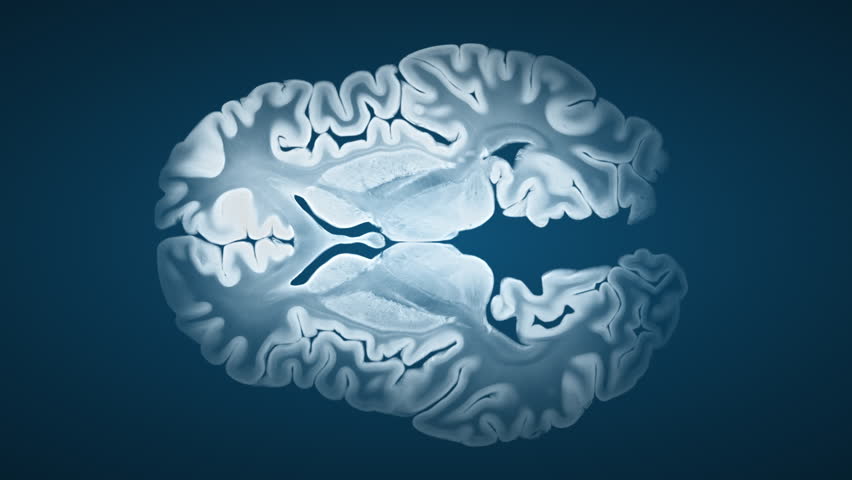 Alzheimer brain progression in axial view showing changes from healthy to diseased brain, highlighting cortical atrophy, widened sulci, and structural degeneration on a blue background.