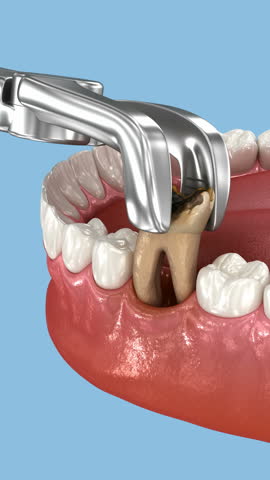 Extraction of tooth. Dental 3D animation