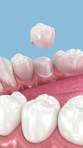 Dental ceramic crown placement. Dental 3D animation
