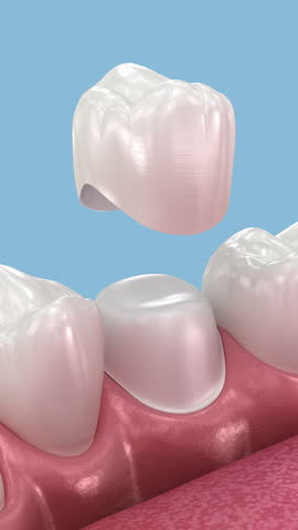 Dental ceramic crown placement. Dental 3D animation