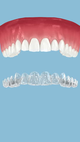 Invisalign braces or invisible retainer. Dental 3D animation