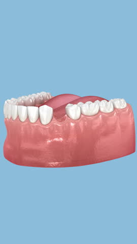 Dental implant and ceramic crown installation. 3D Animation
