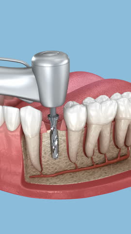 Dental implant and ceramic crown installation. 3D Animation