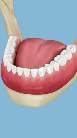 Peri-implantitis and gingiva recession. Dental 3D animation