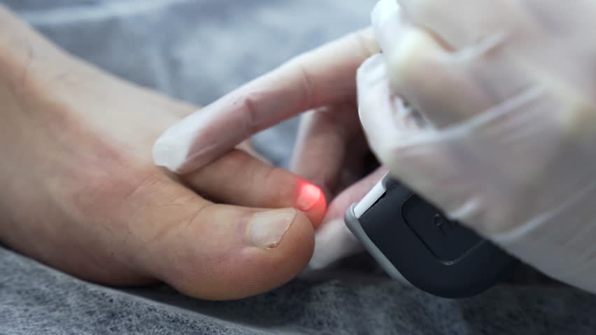 close up woman doctor doing laser treatment procedure for toenail fungus. Fungal infection on the nails. Treatment of onychomycosis with a medical laser