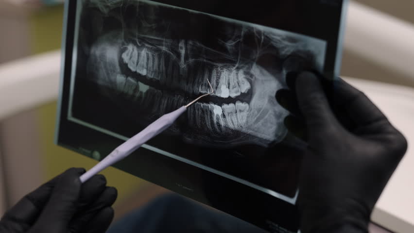 X-ray examination, Tooth health, Dental diagnosis. Gloved hand uses dental tool to carefully examine details of dental X-ray.