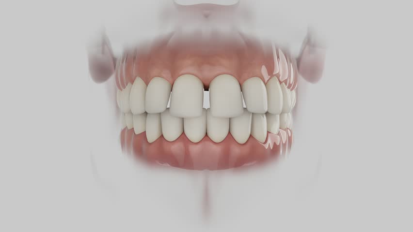 3D Dental Animation — Teeth Spacing Correction with Clear Aligner
